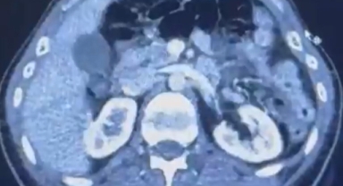 ÜLKEYE MİDELERİNDE UYUŞTURUCU GETİREN ŞAHISLAR YAKALANDI